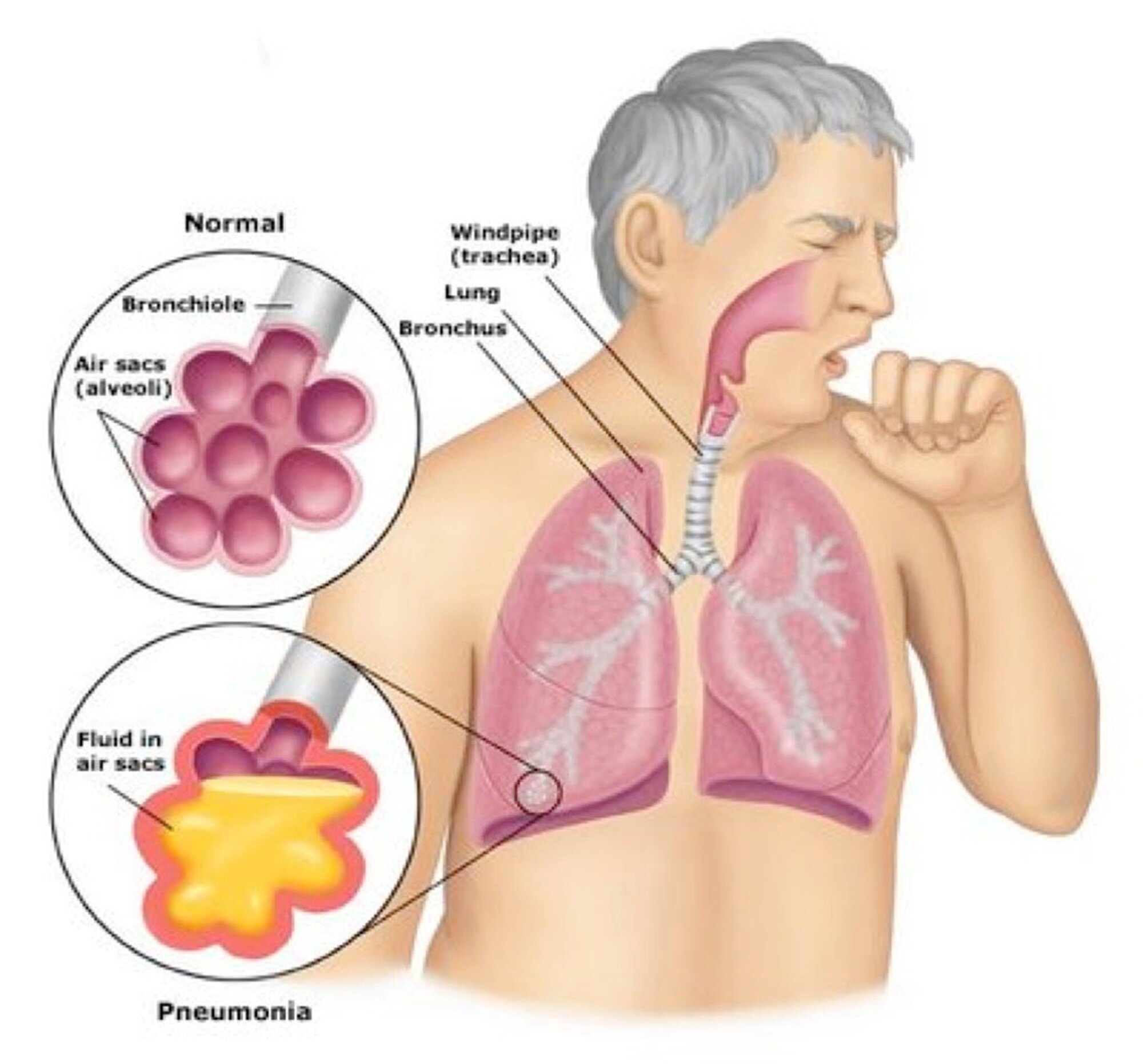 legionnairesdisease-1 legionnairesdisease-1
